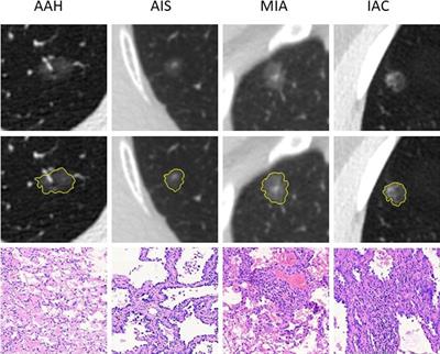 Evaluation of the Radiomics Method for the Prediction of Atypical Adenomatous Hyperplasia in Patients With Subcentimeter Pulmonary Ground-Glass Nodules